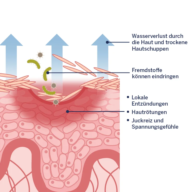 Hautgrafik: Atopische Haut