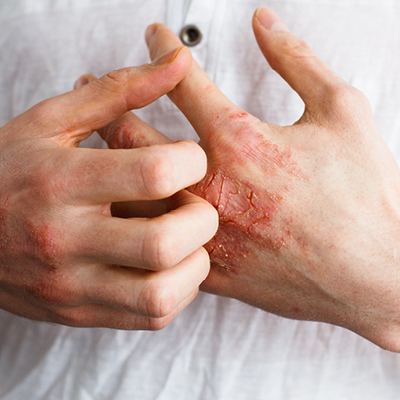 Mani con sintomi di dermatite atopica