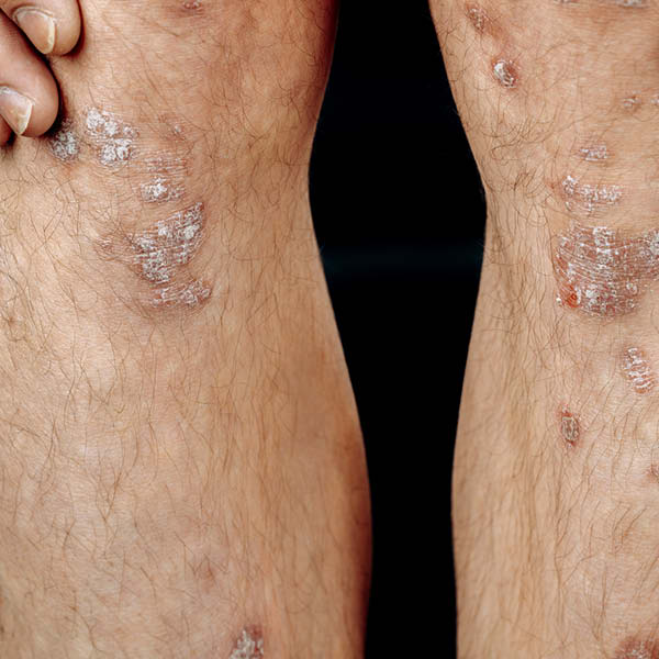 Foto von Schuppenflechte (Schuppenflechte (Psoriasis vulgaris) an Knie und Schienbein