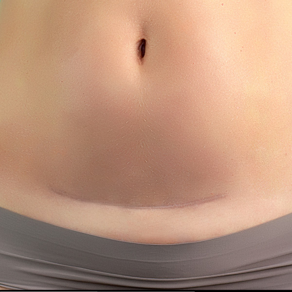 Bauch mit gut verheilter Kaiserschnittnarbe