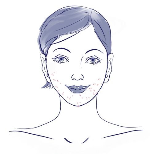 Illustratie: acne tarda op het gezicht 