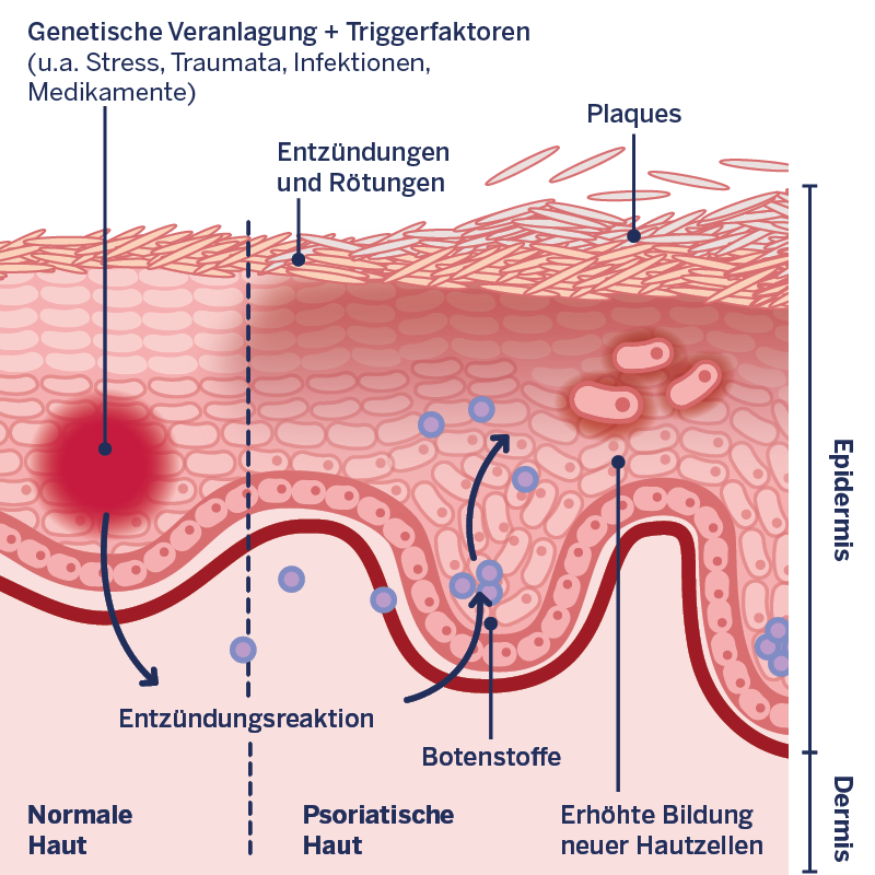 Die Bildung einer Psoriasis wird anhand einer Hautgrafik veranschaulicht