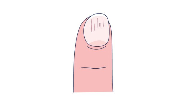 Illustration eines Nagels mit Splitterblutungen unter dem Nagelbett