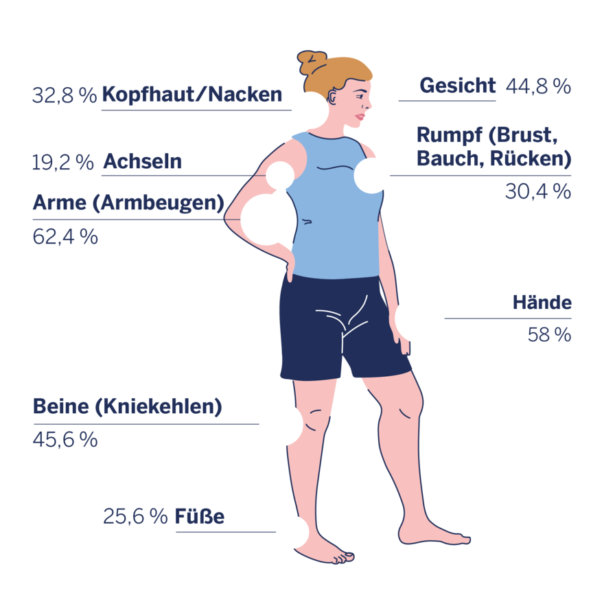 Infografik zu den von Neurodermitis betroffenen Körperstellen bei Frauen.