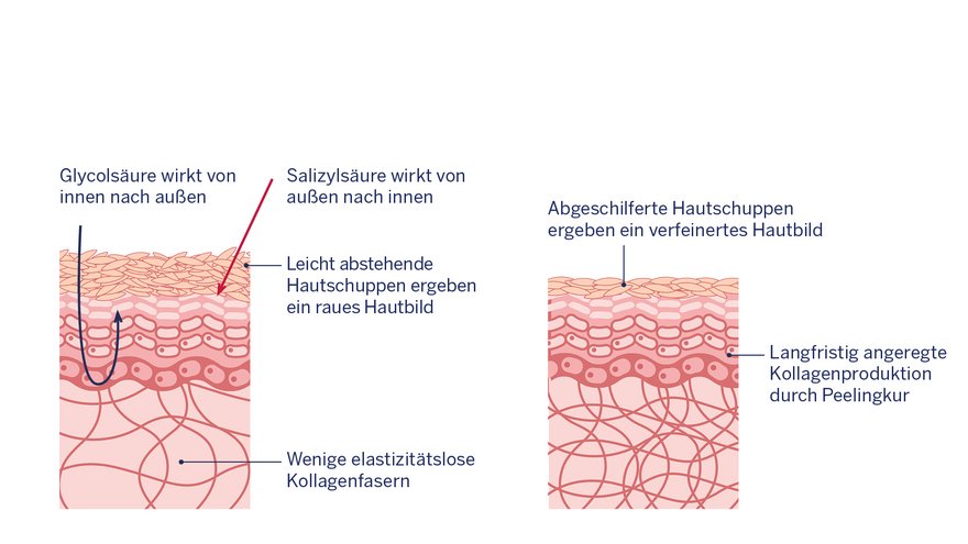 Grafik: Hautveränderung nach der Anwendung von Fruchtsäuren