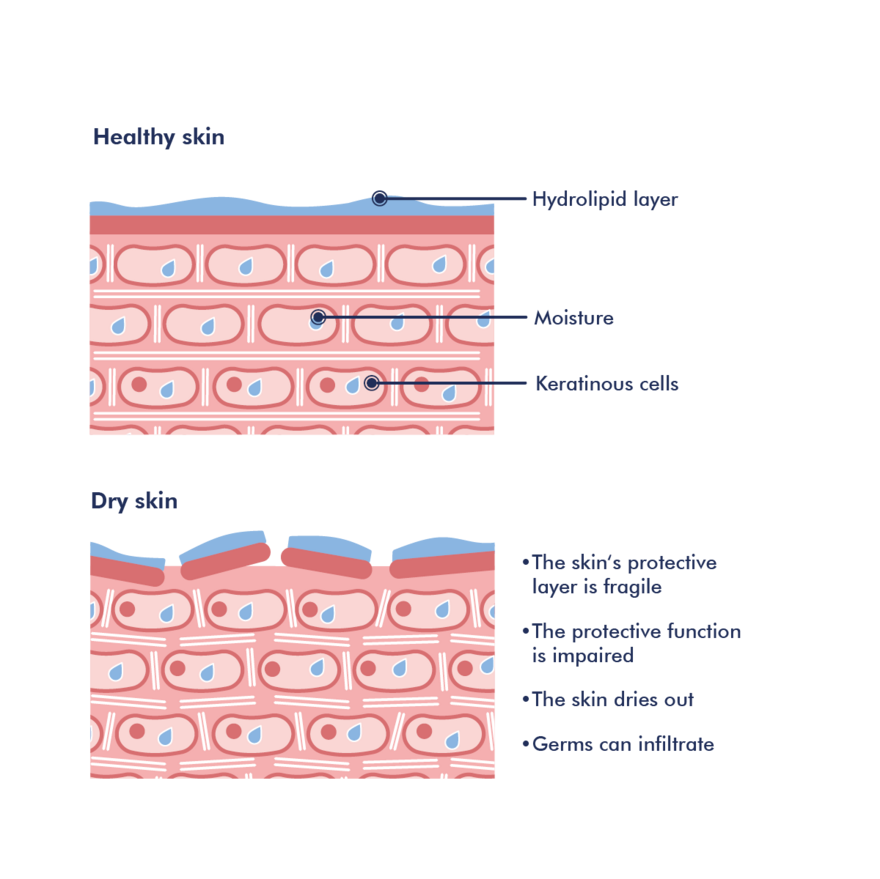 Illustration of dry skin